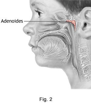 adenoides